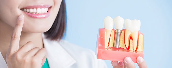 כל מה שצריך לדעת על השתלות שיניים